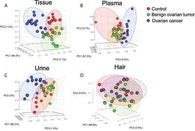 Complex metabolic interactions between ovary, plasma, urine, and hair in ovarian cancer